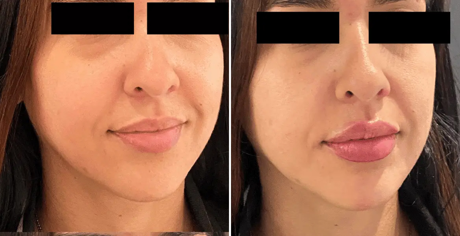 Dermal Fillers Before & After