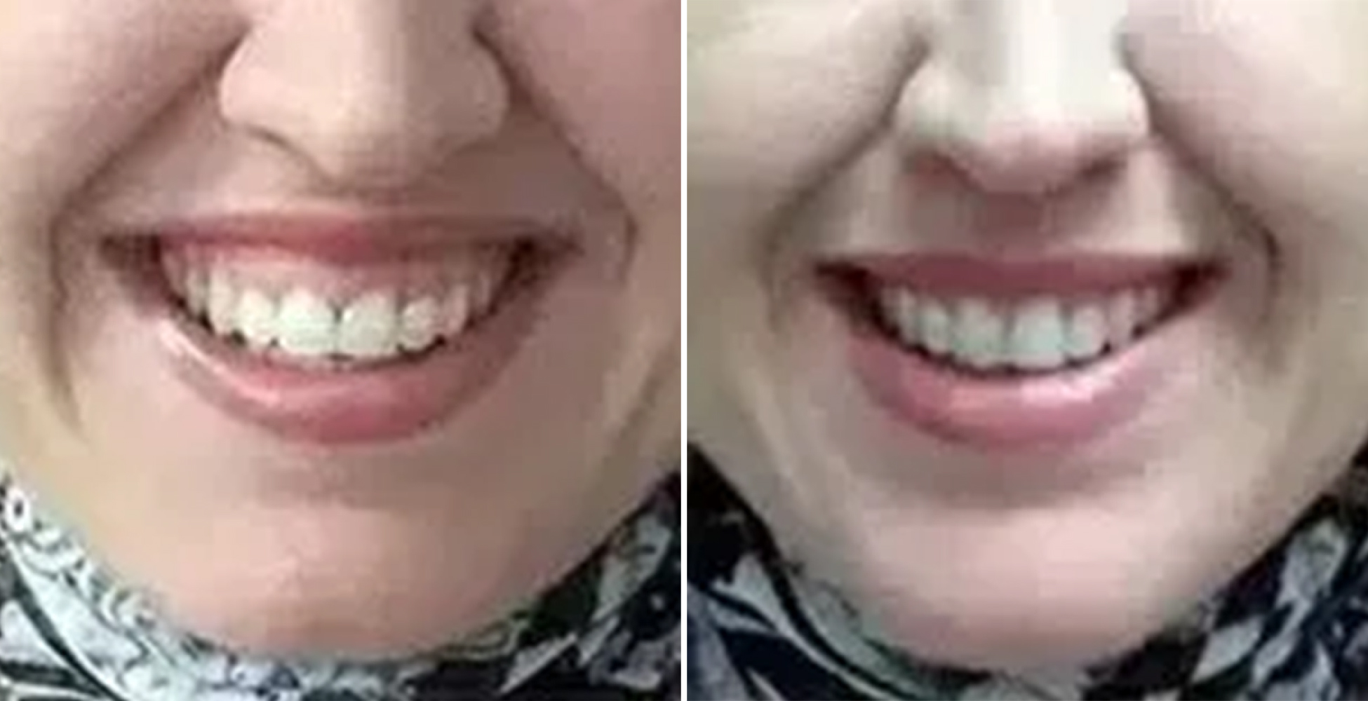 Gummy Smile Before & After