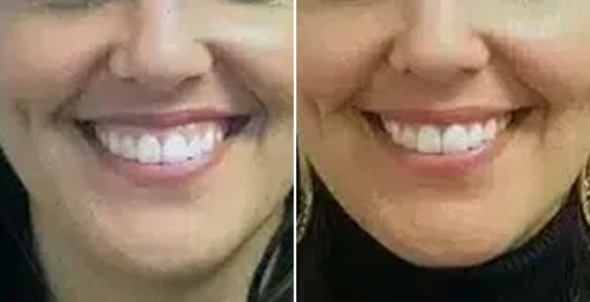Gummy Smile Before & After