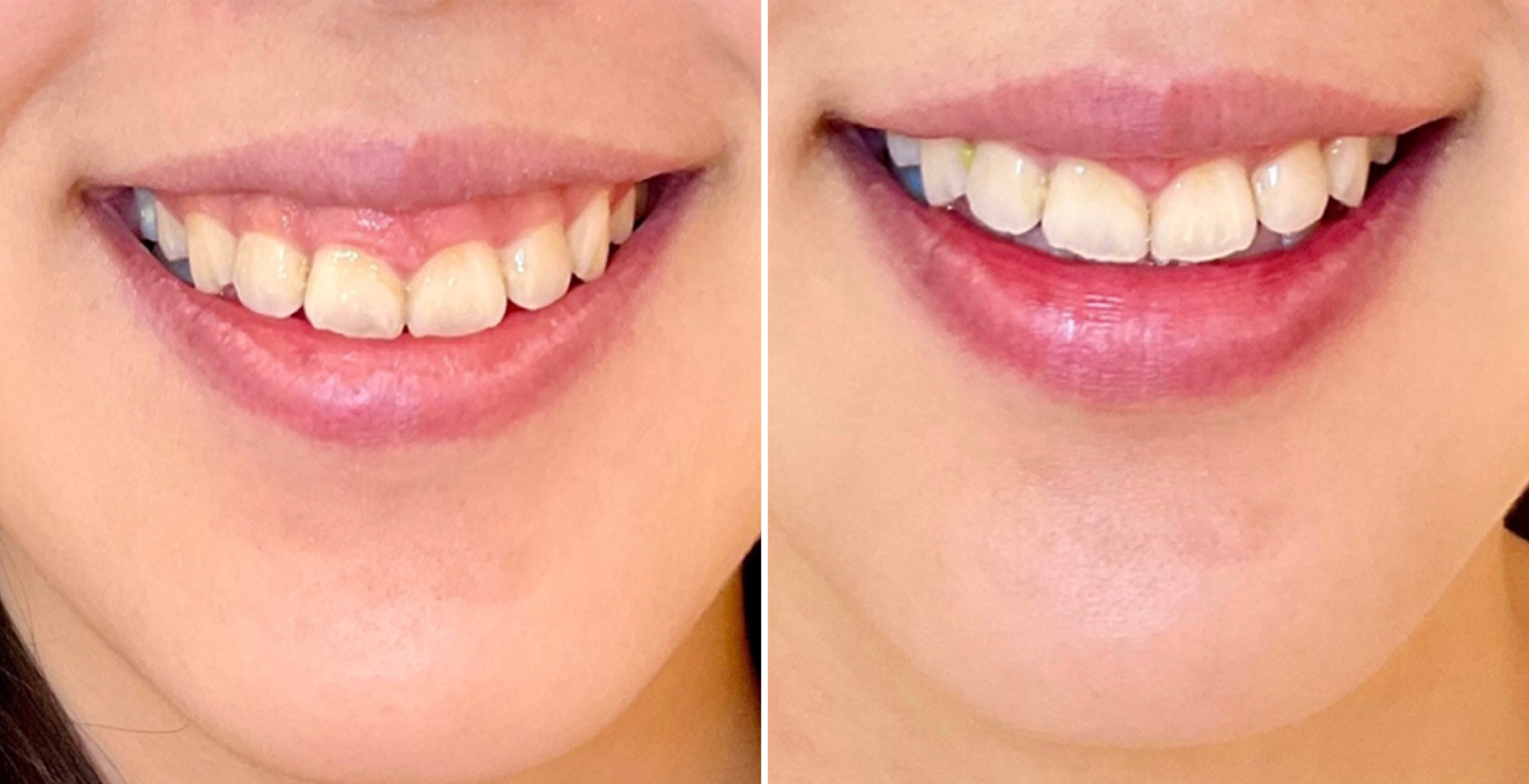 Gummy Smile Before & After