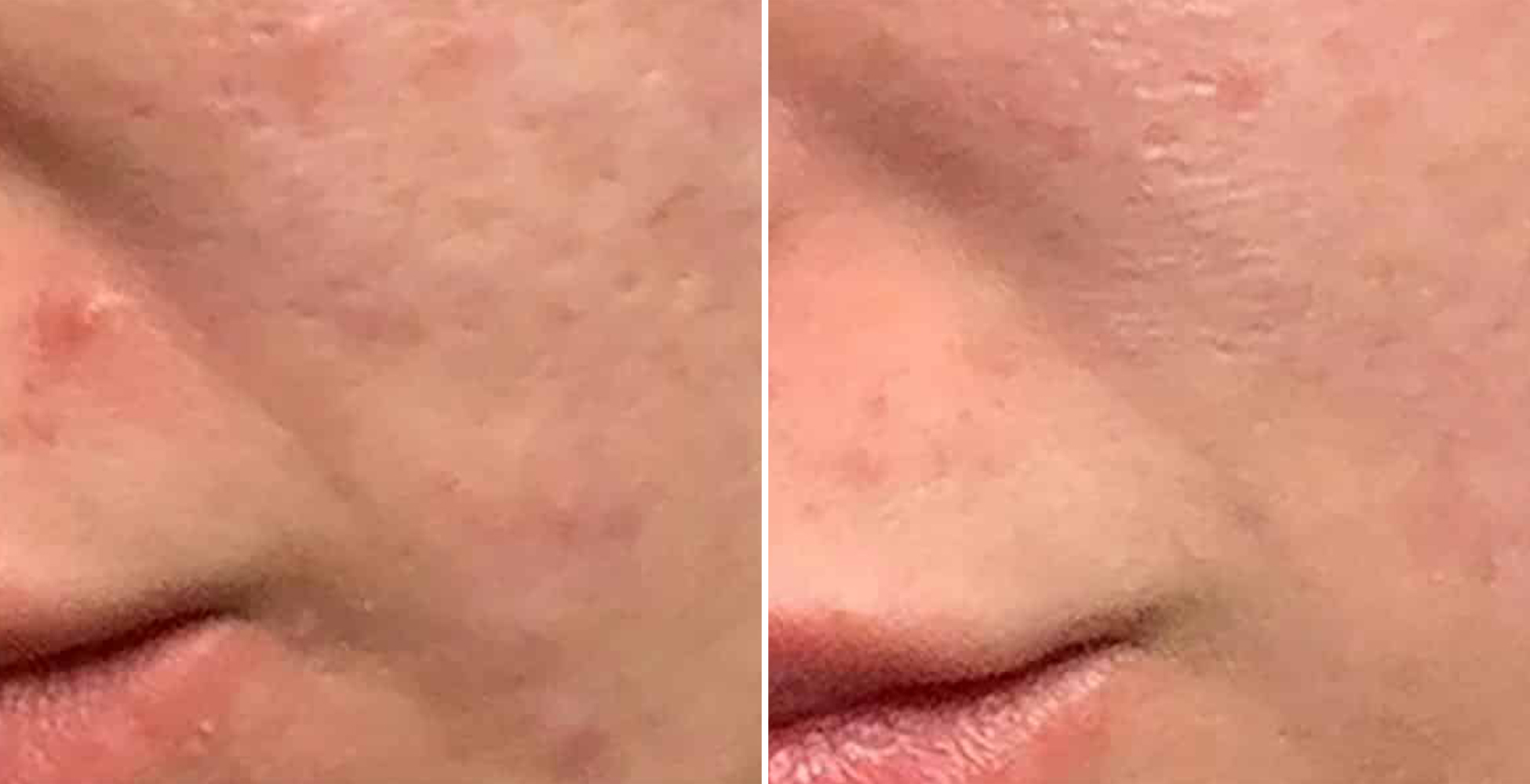 Morpheus 8 Before & After