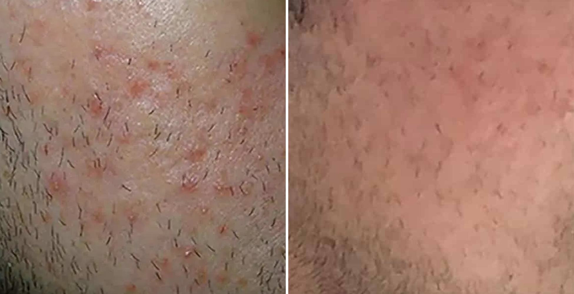 Morpheus 8 Before & After