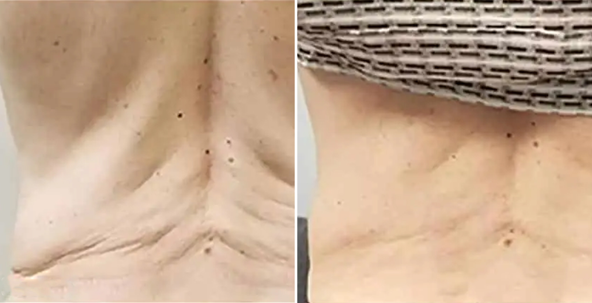 Morpheus 8 Before & After