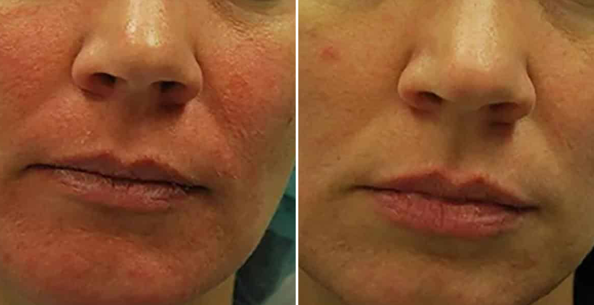 Morpheus 8 Before & After