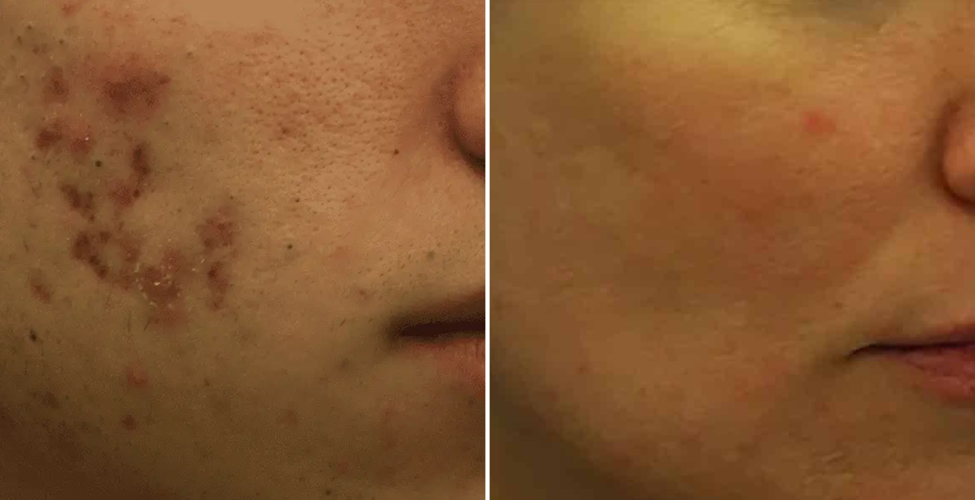 Morpheus 8 Before & After