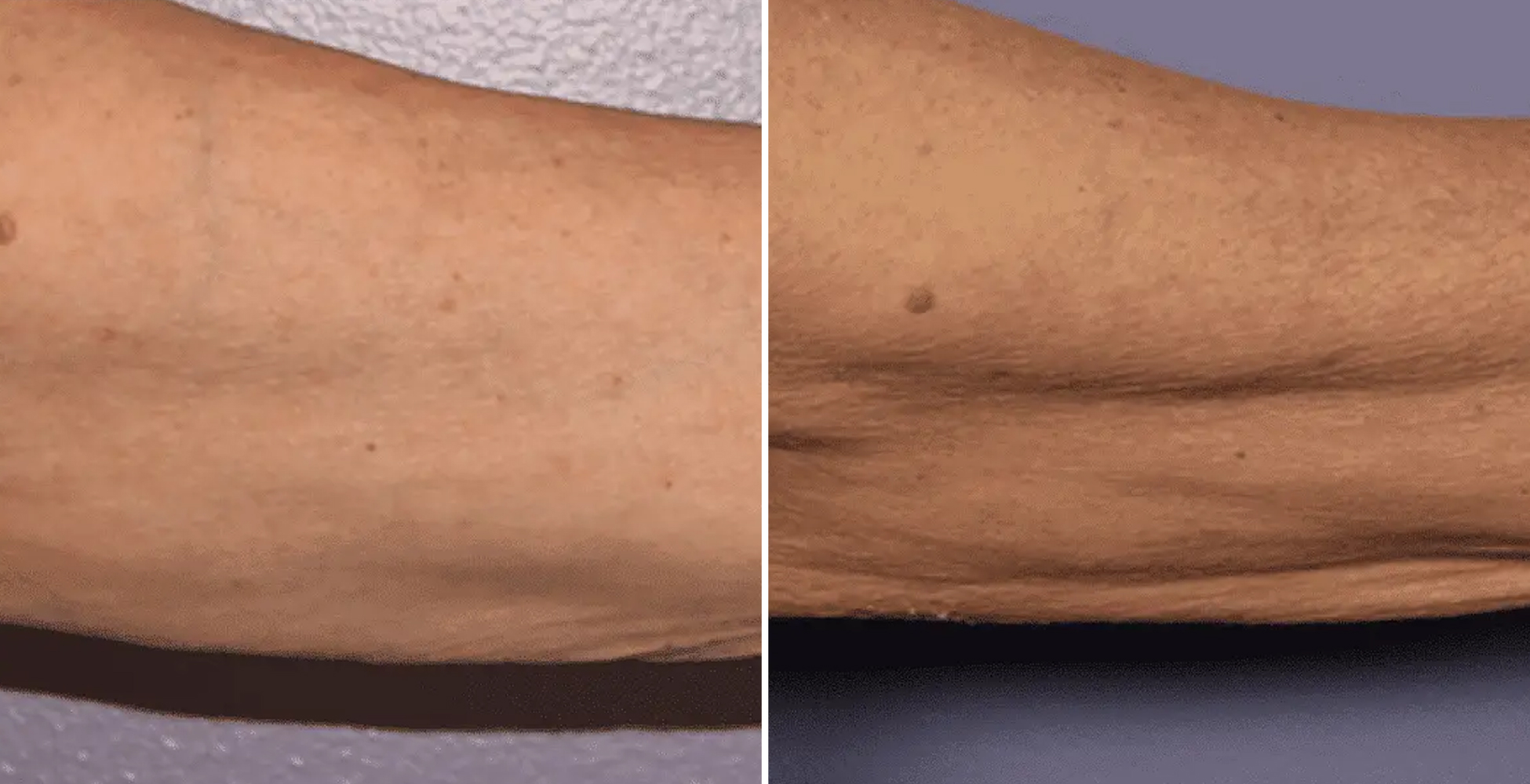 Morpheus 8 Before & After