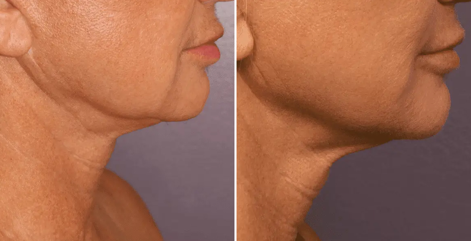 Morpheus 8 Before & After