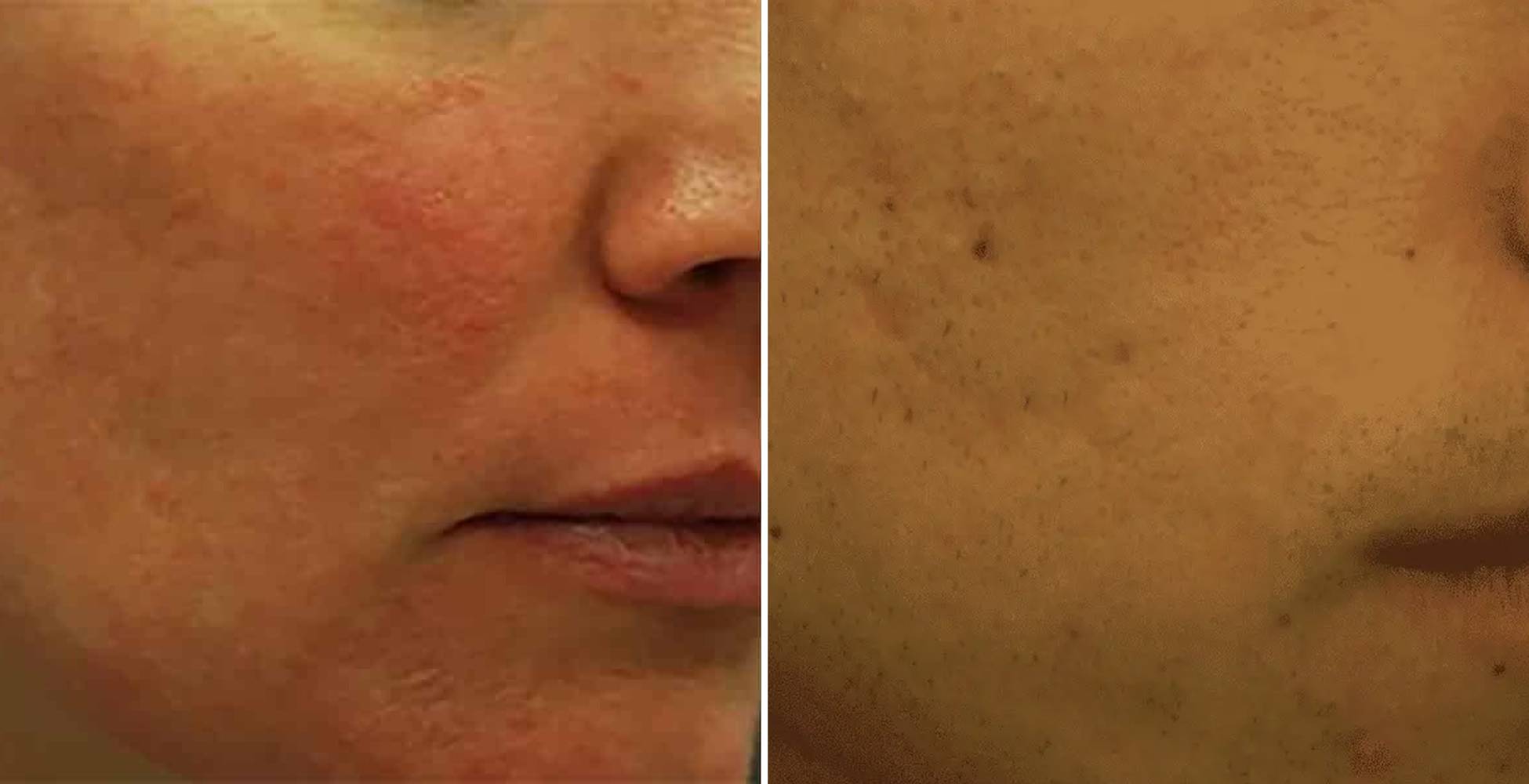 Morpheus 8 Before & After