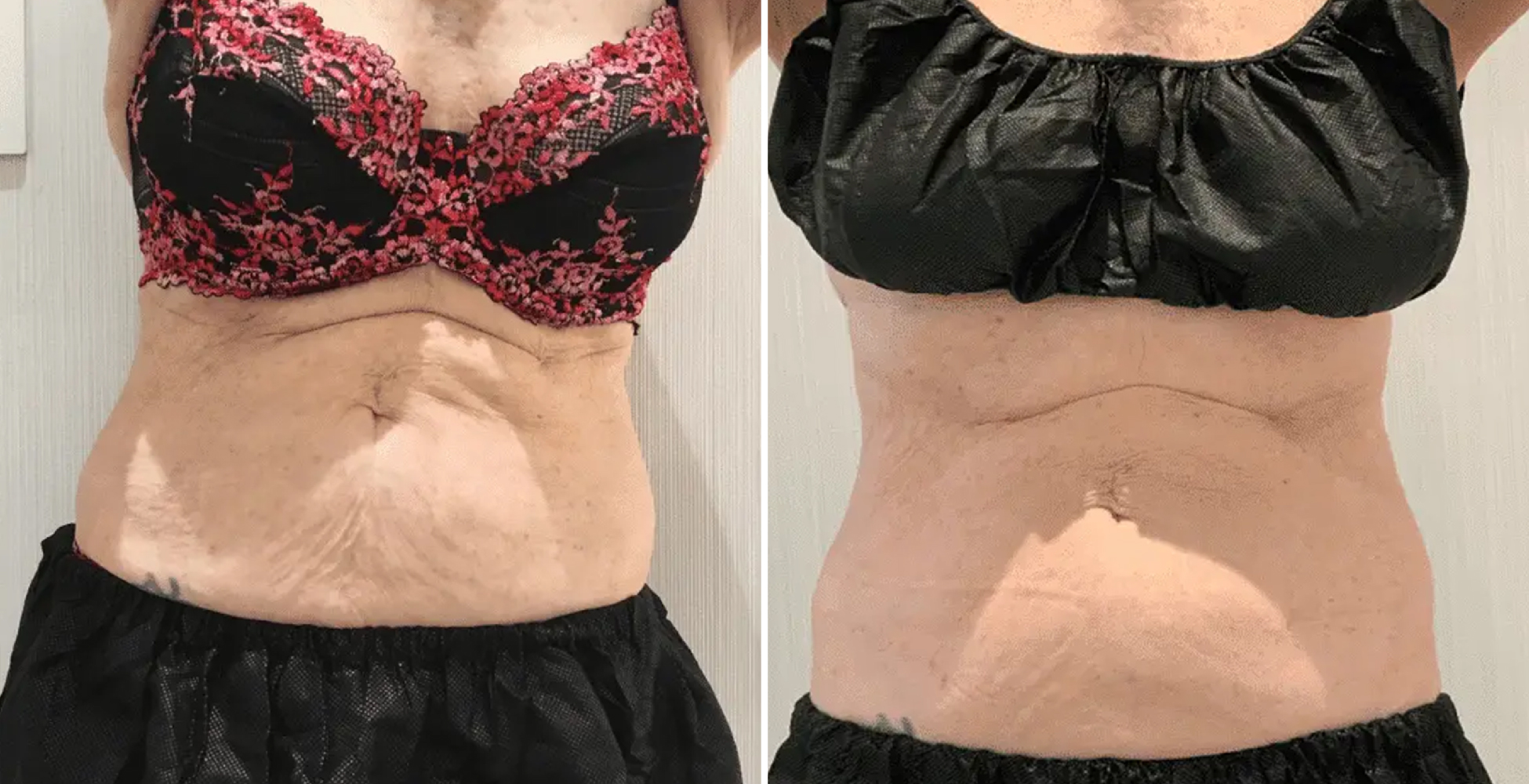 Morpheus 8 Before & After