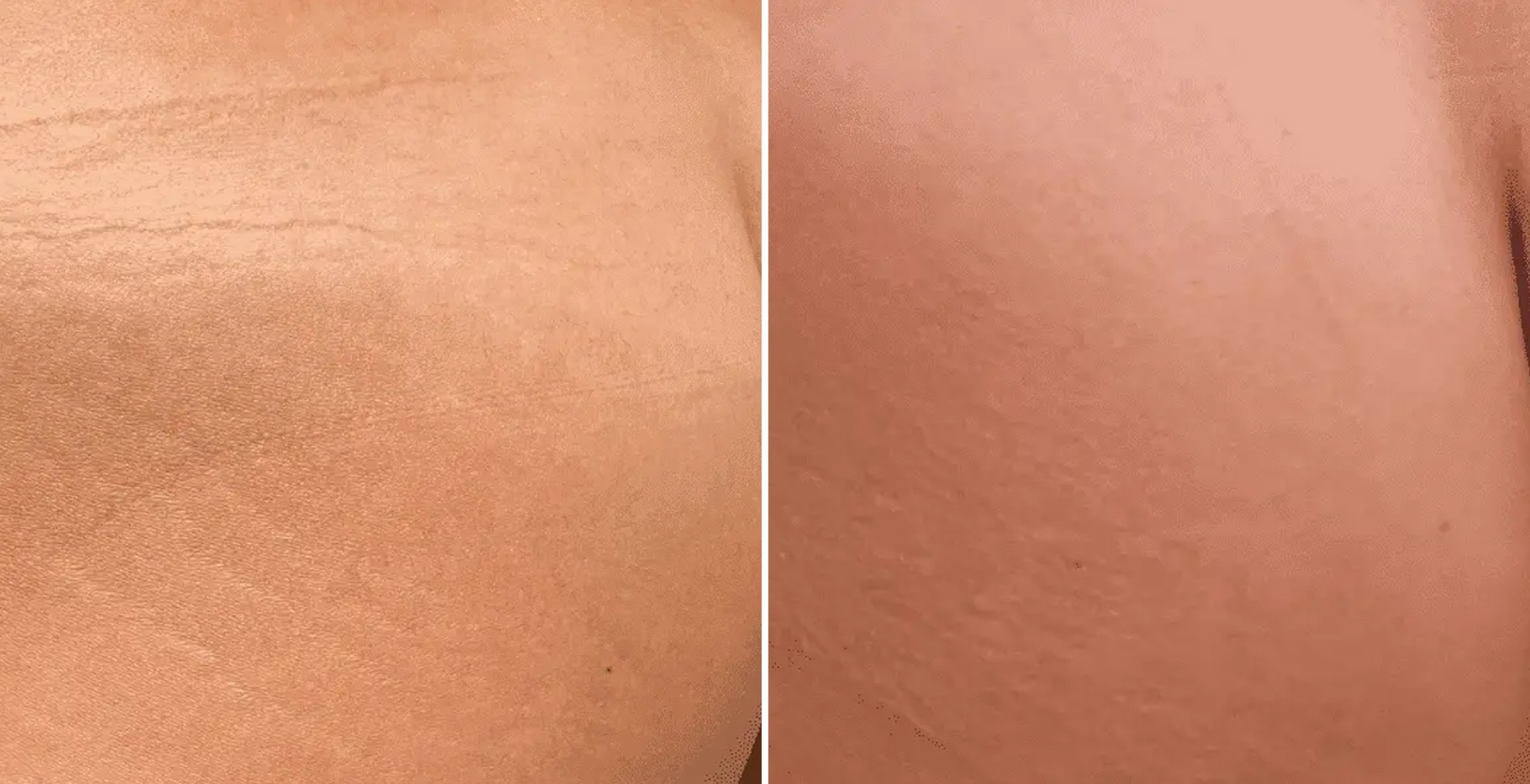 Morpheus 8 Before & After