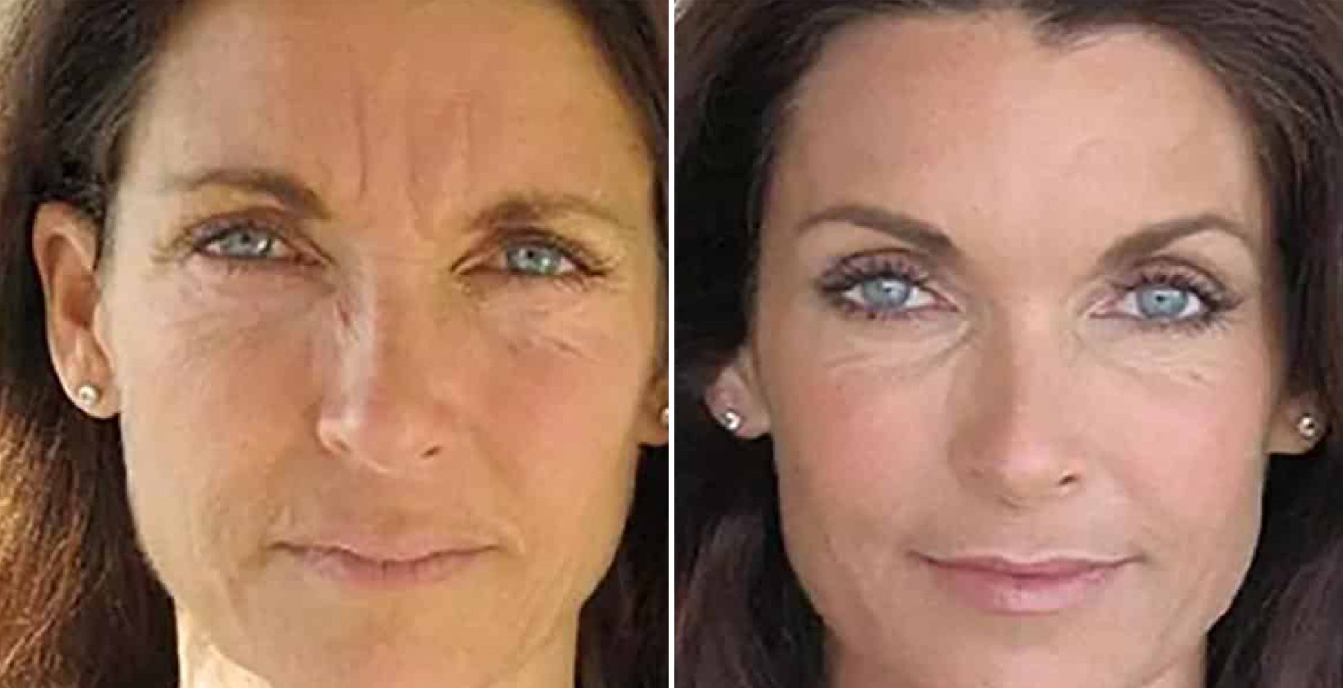 Photofacial Before After