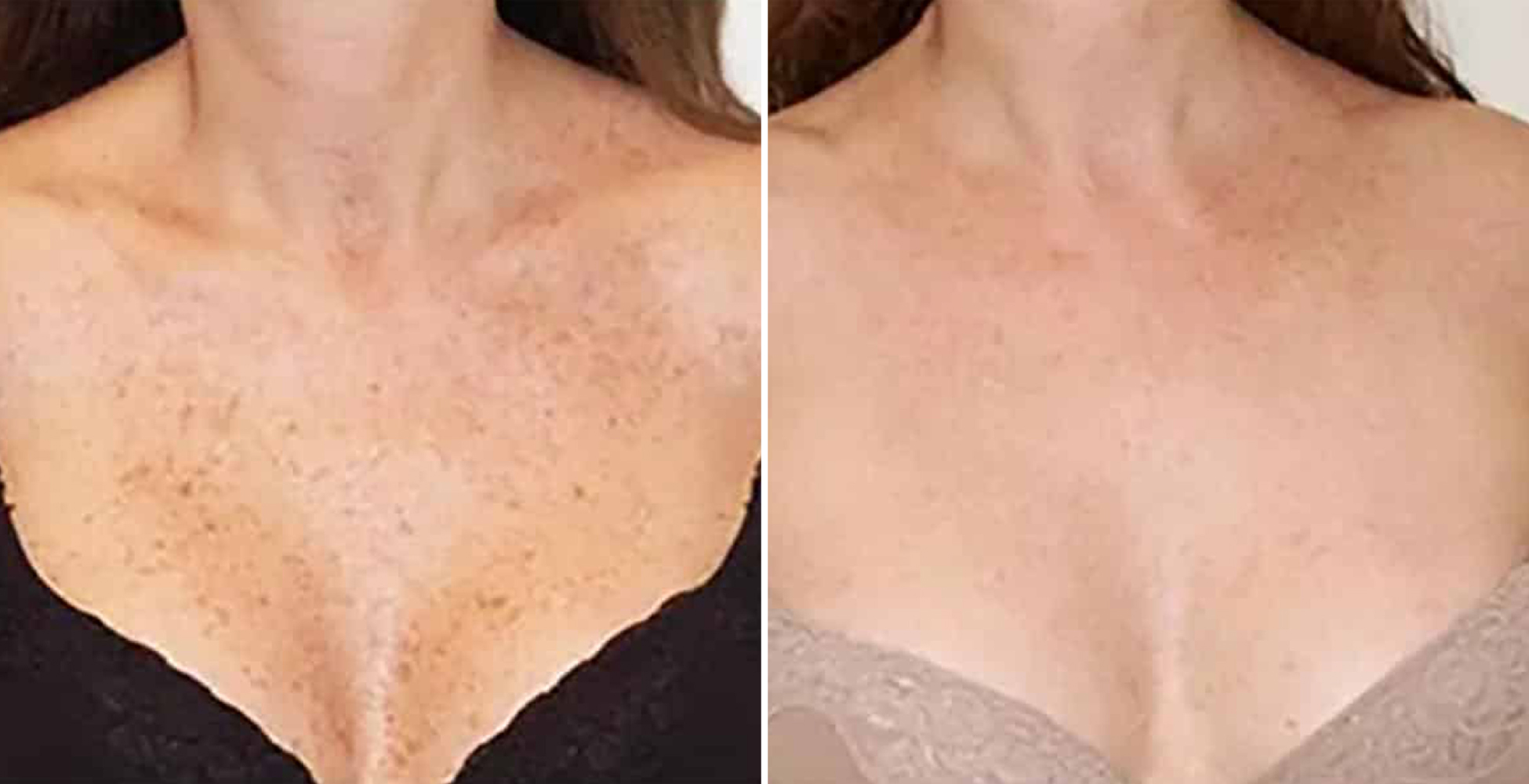 Photofacial Before After