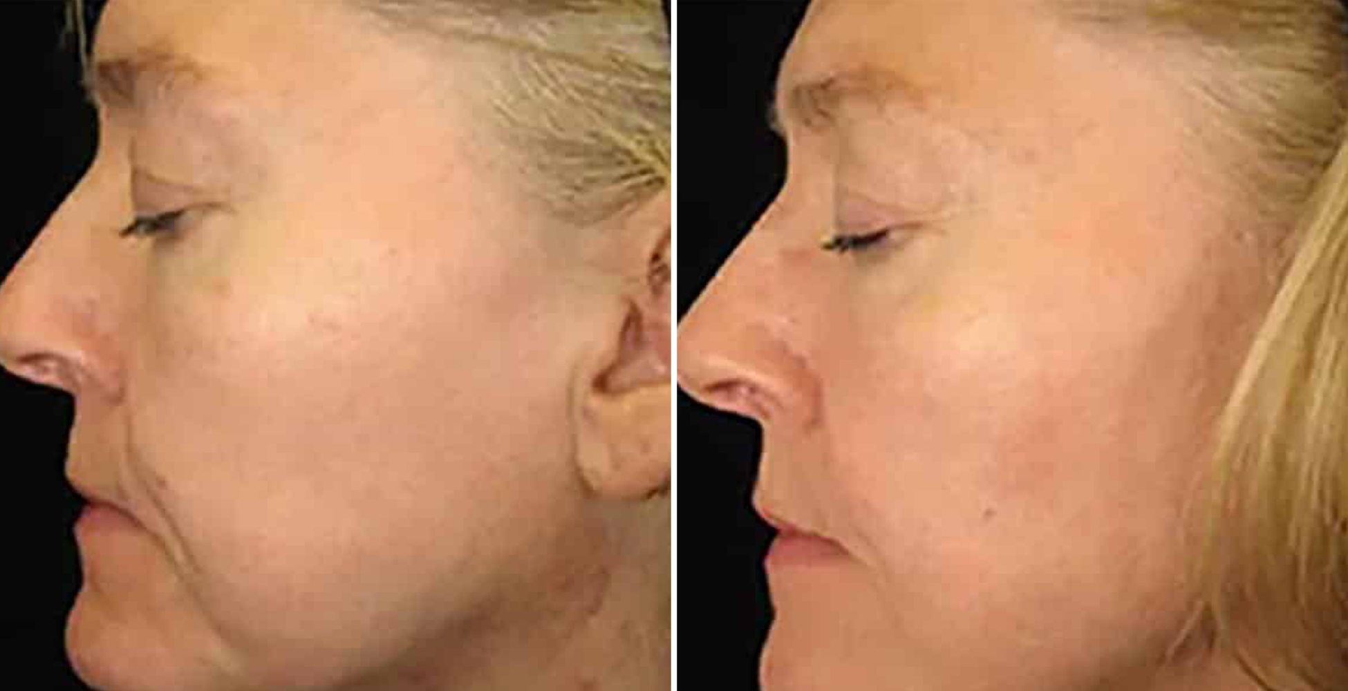 Photofacial Before After