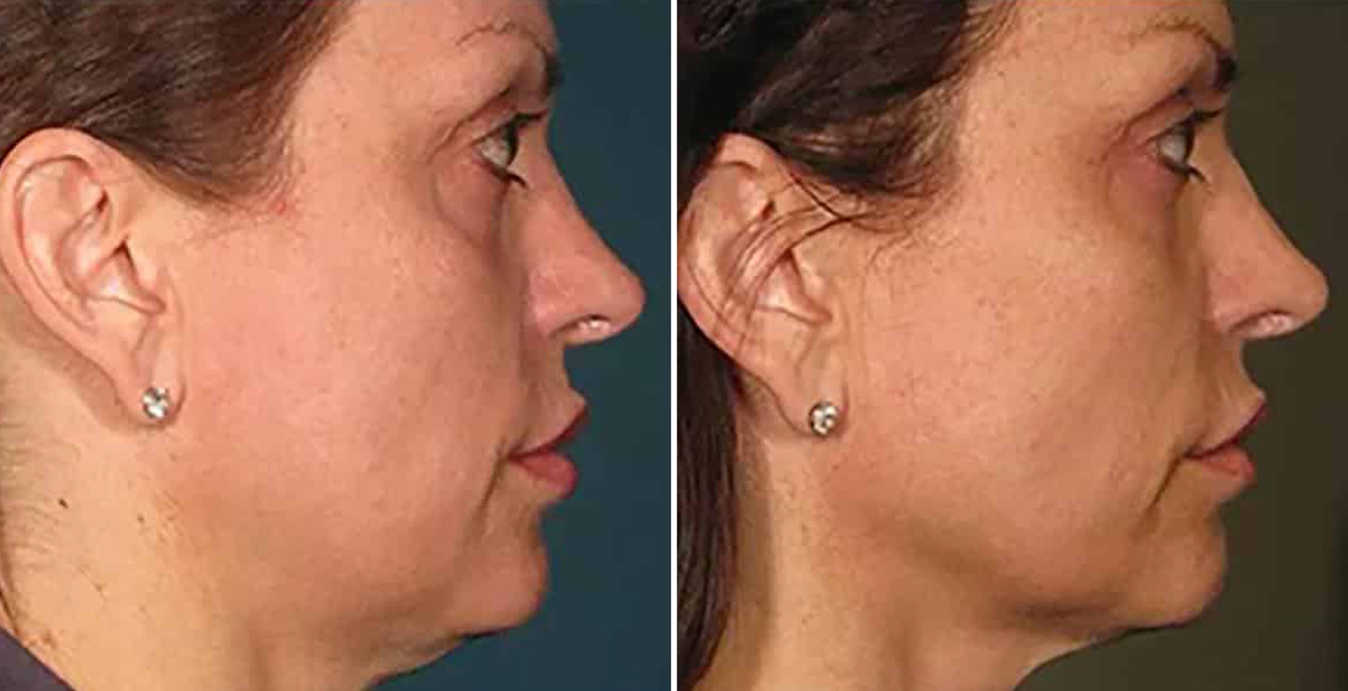 Ultherapy Before & After