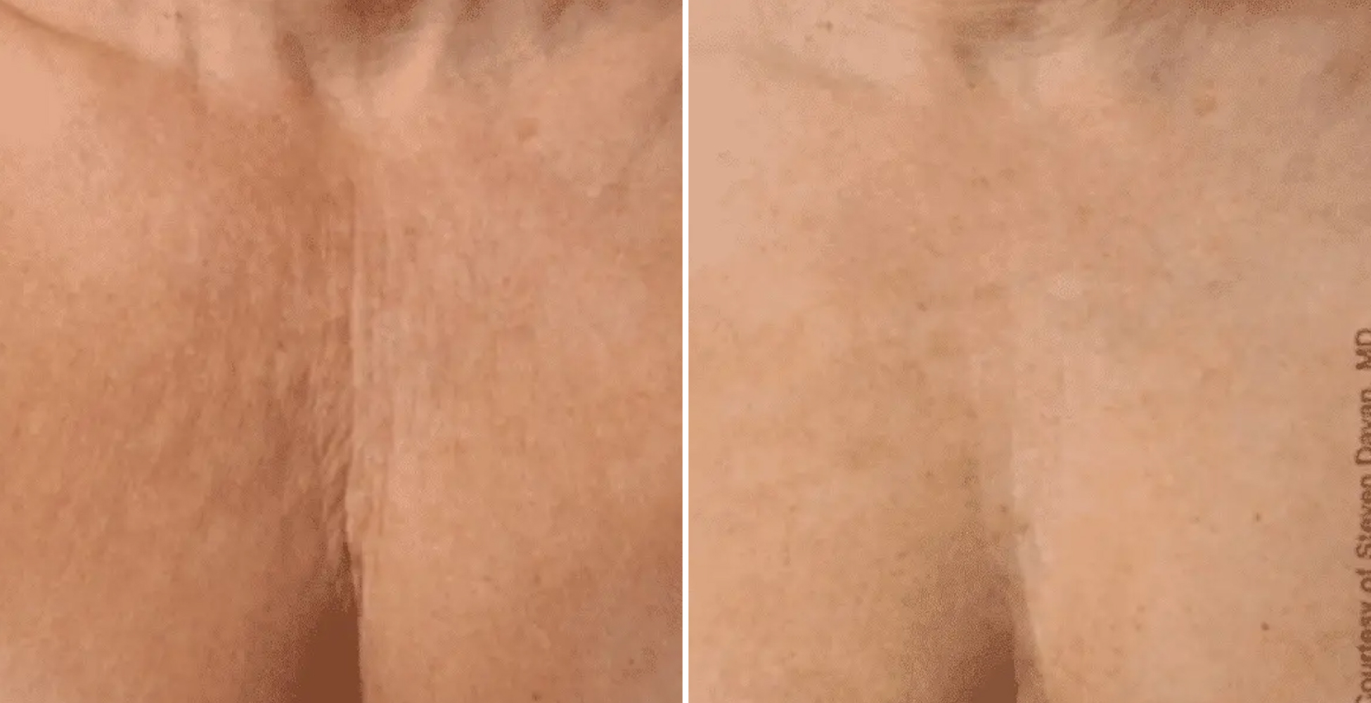 Ultherapy Before & After