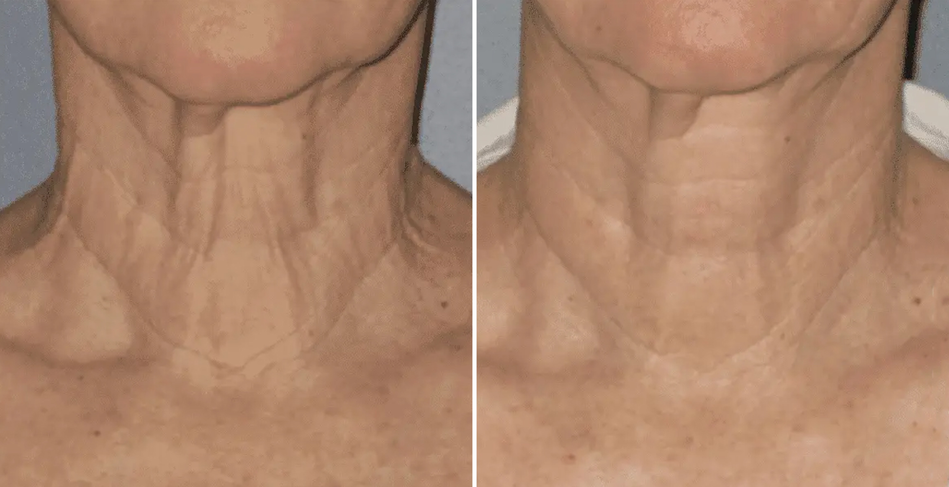 Ultherapy Before & After