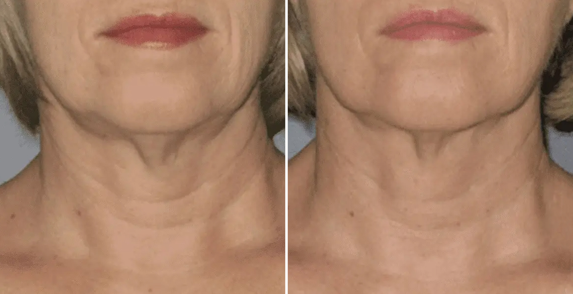 Ultherapy Before & After