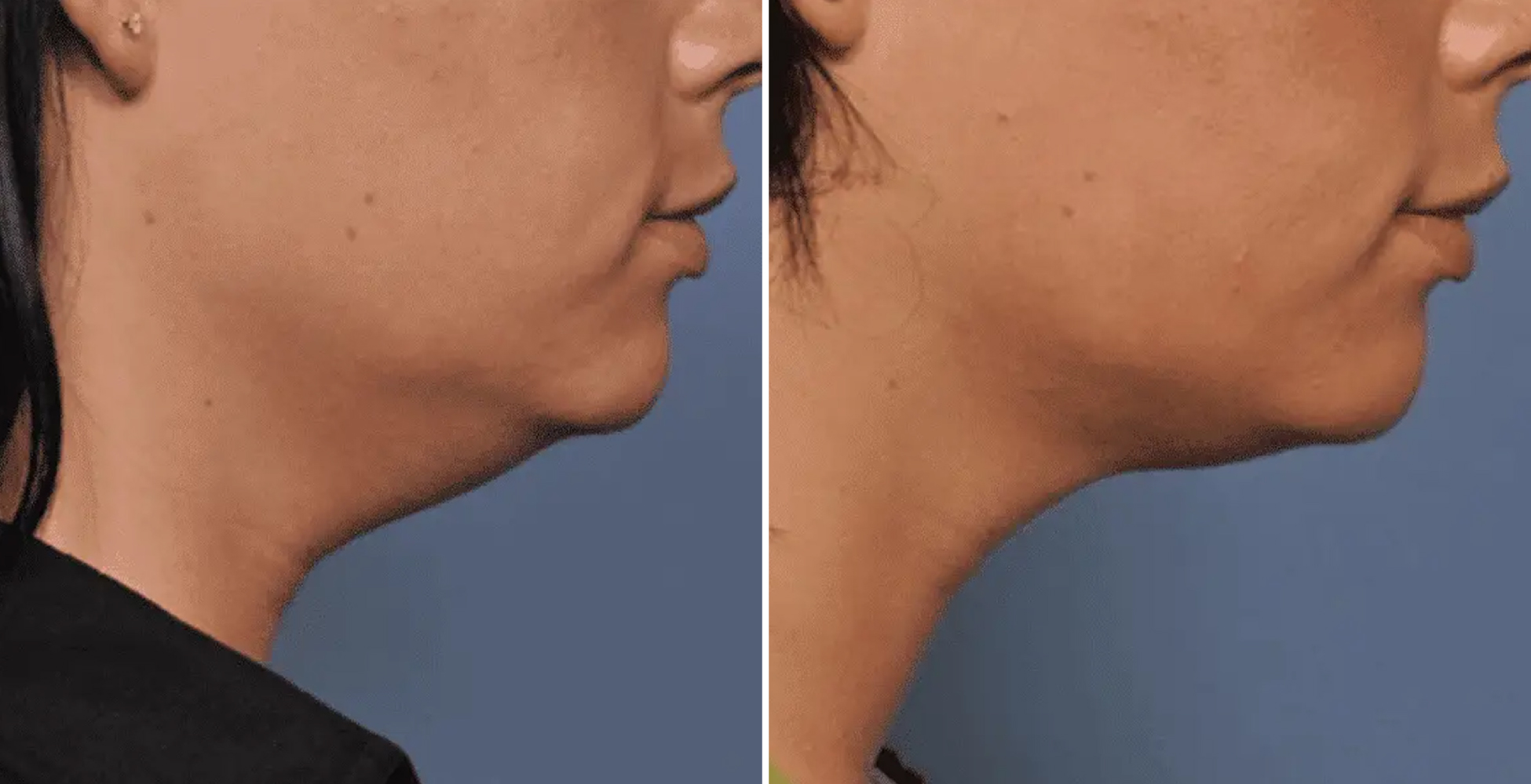 Ultherapy Before & After