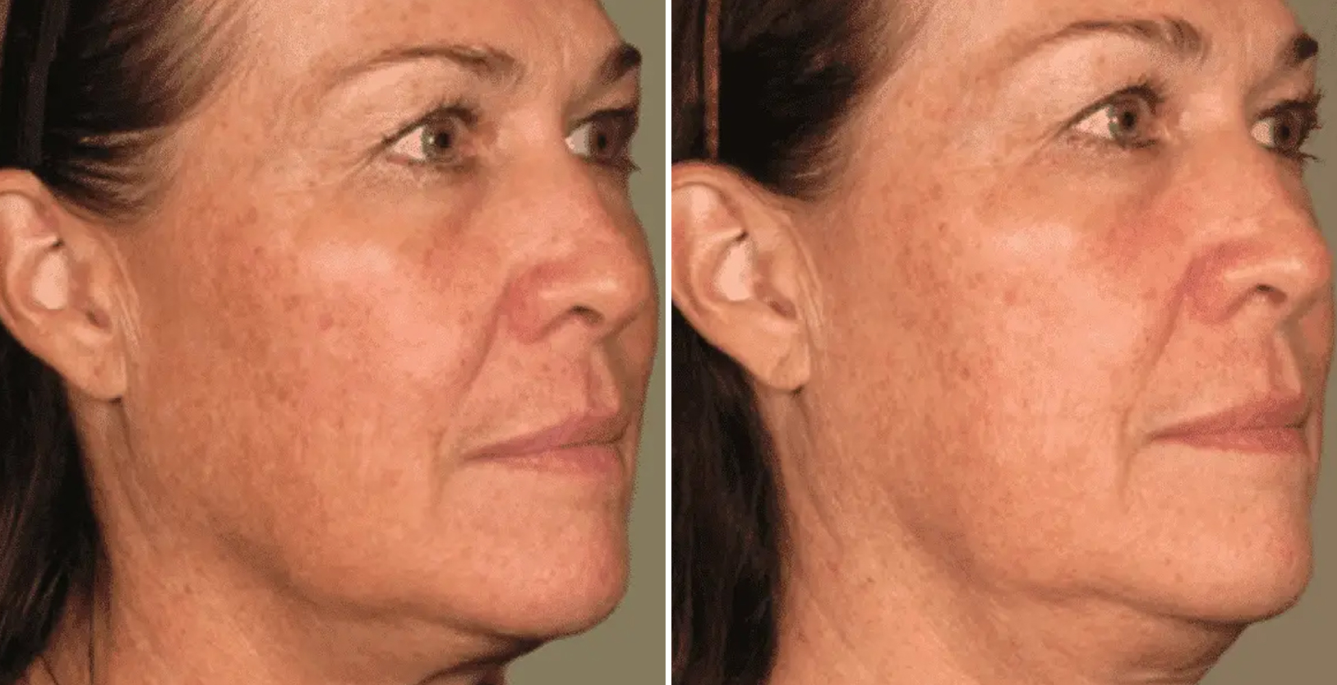 Ultherapy Before & After