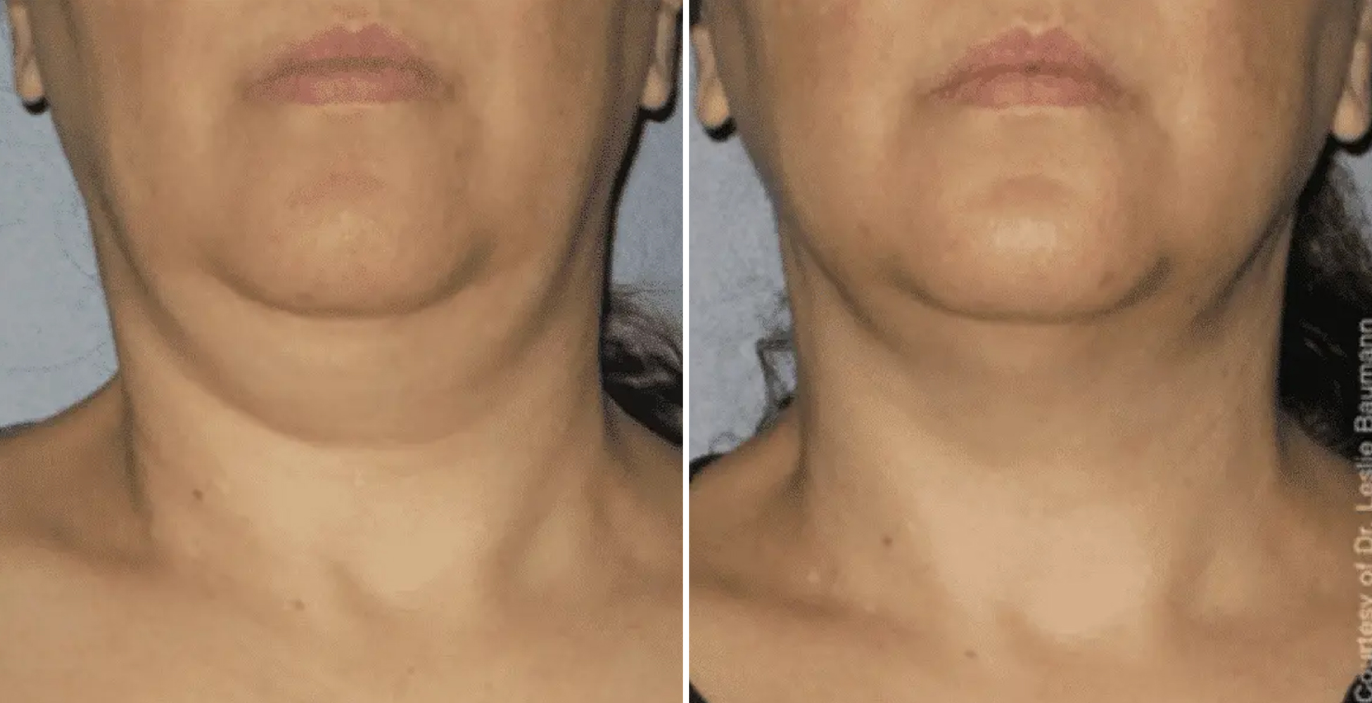 Ultherapy Before & After
