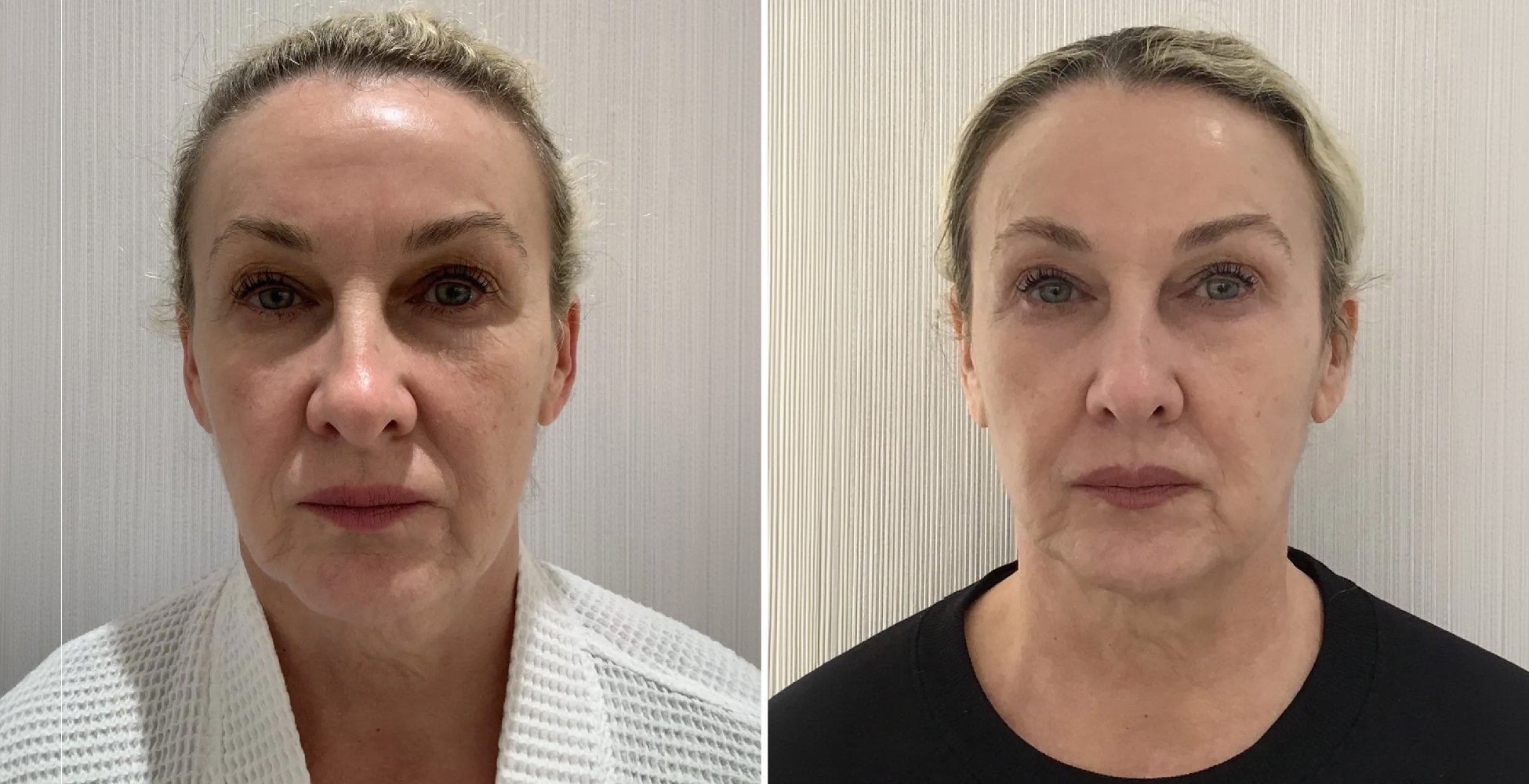 Ultherapy Before & After