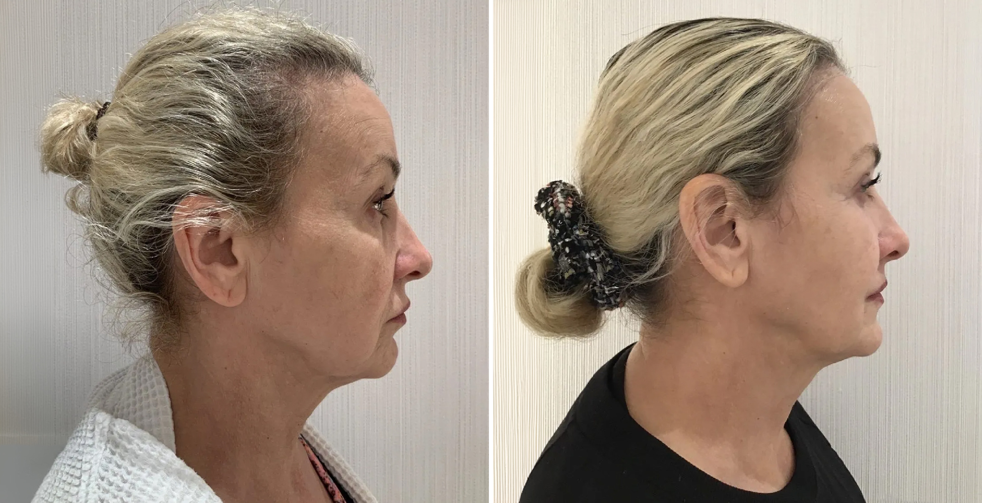 Ultherapy Before & After