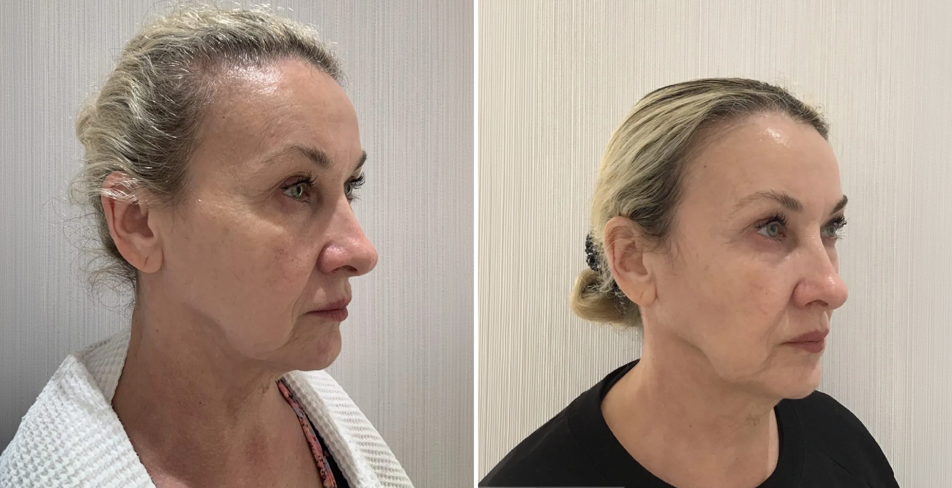 Ultherapy Before & After