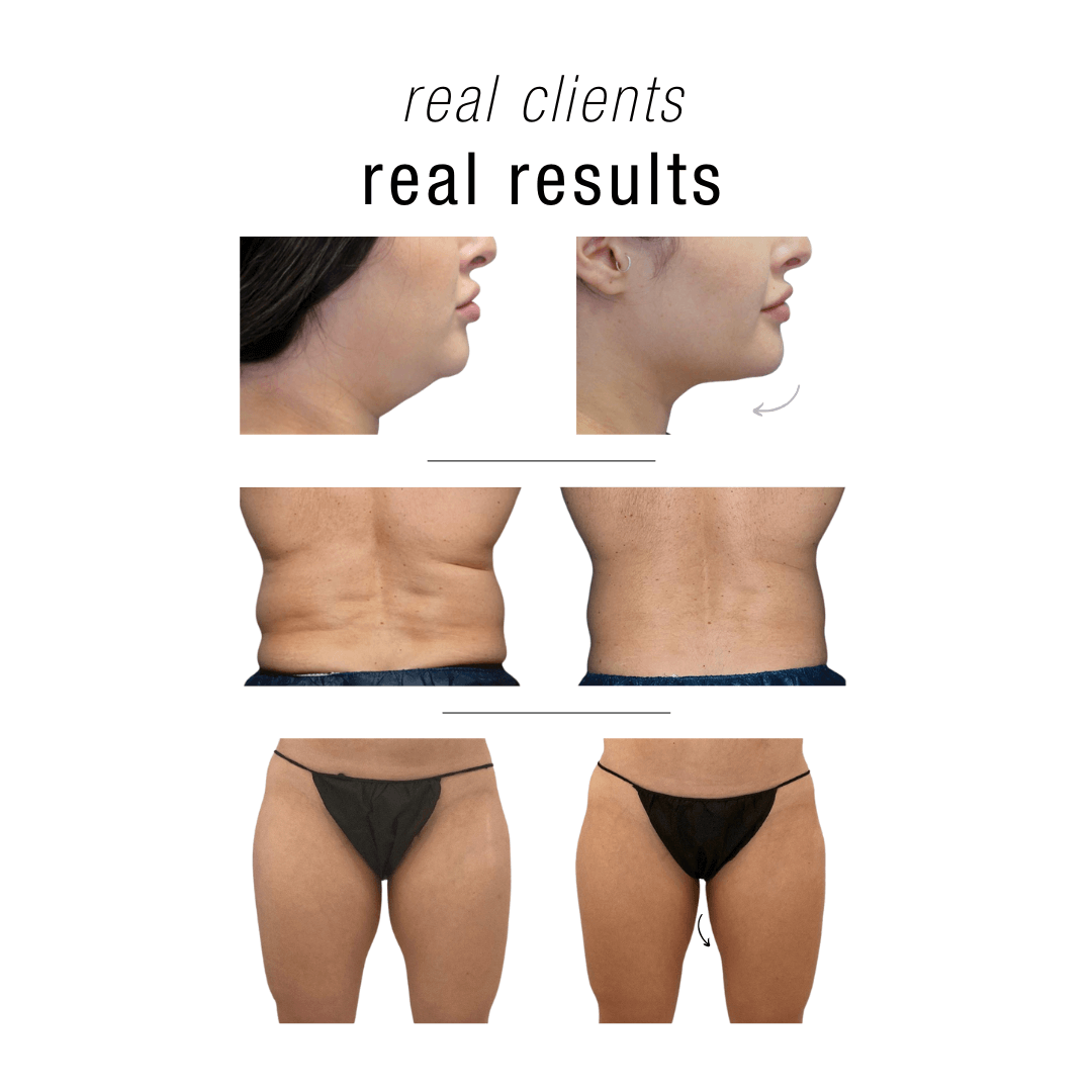 Coolsculpting NYC Manhattan
