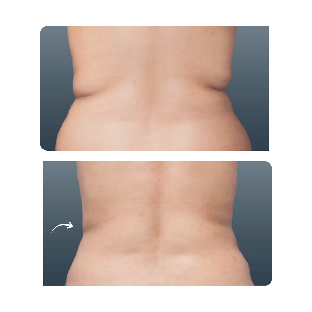 Coolsculpting NYC Manhattan