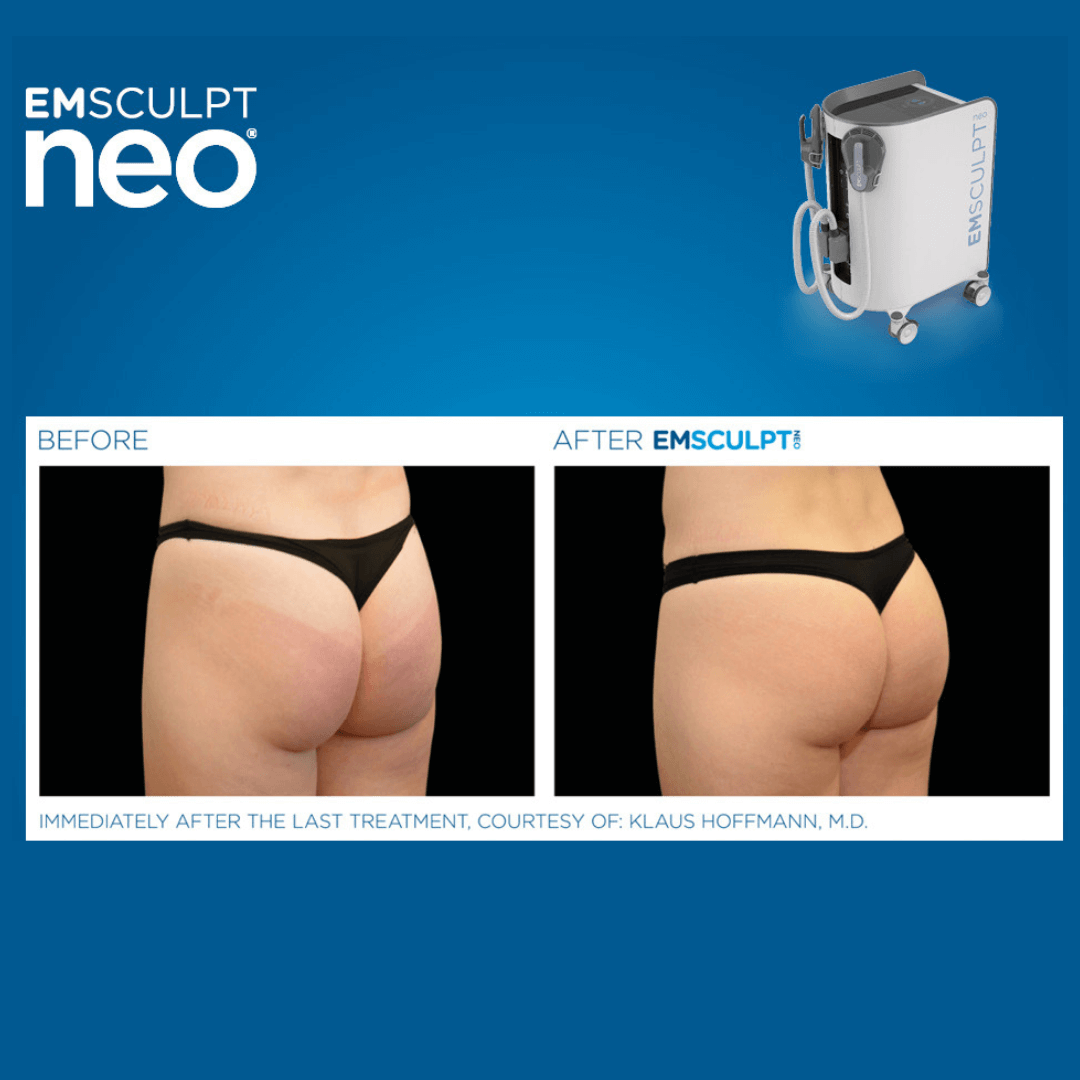 Emsculpt NEO