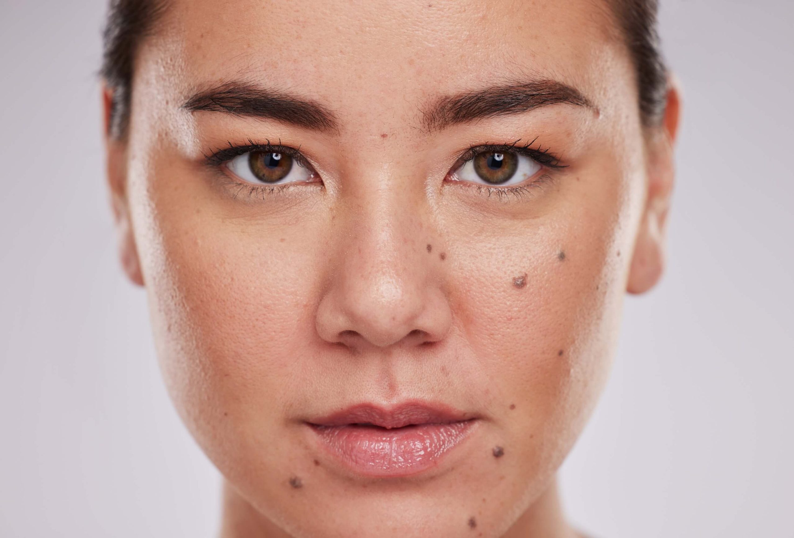 treat acne and aging